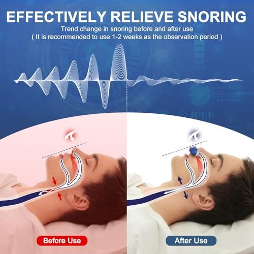 Anti Snore Device,Double Vortex Electric Double Vortex Snoring Solution,Mini Portable Stop Snoring Devices Stopper,Adjustable Wind Speed Snoring Prevention Nasal Dilators,Up to 8 Hours