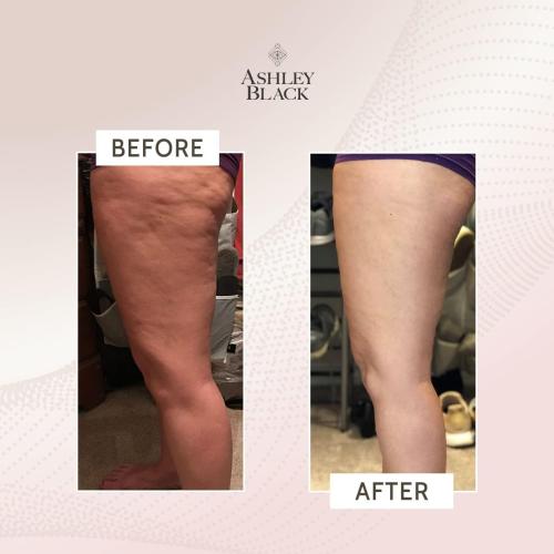 FasciaBlaster The ProBlaster Handheld by Ashley Black. Scientifcally Proven MyoFascial Tools. Gentle Massage with Effective Results. Releive Full Body Tension and Anti-Cellulite