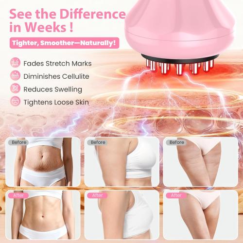 Lymphatic Drainage Massager, Handheld Massage tools for lymphedema & lipedema, Anti-Cellulite Massager For Body Cellulite and Thigh & Belly Stretch Marks Reduction, Sciatica Nerve pain relief Devices