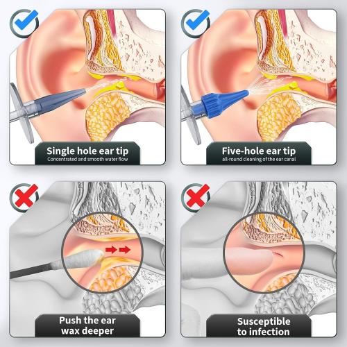 Ear Wax Removal, Ear Cleaner, Ear Cleaning Kit, Manual Ear Irrigation Flushing System, Ear Wax Removal Kit, Safe and Effective to Clean Ear Built Up Wax