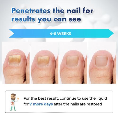 Toenail Fungus Treatment At Home: Nail Fungus Treatment Extra Strength Fast Acting One Week - Safely Repair Renew Damaged And Discolored Toenails - Effectively Improve Athlete's Nail Health