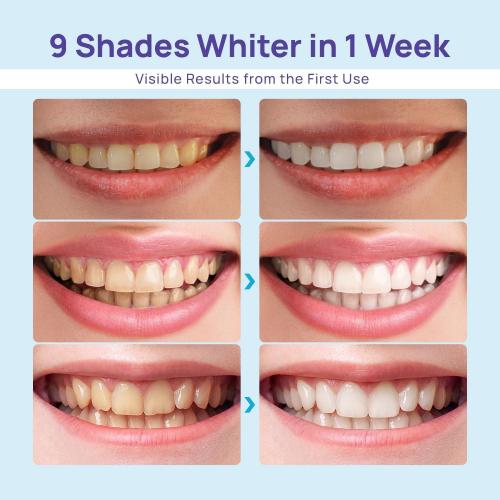 Whitebite Pro Teeth Whitening Kit for Sensitive Teeth – Dual LED Light   35% Carbamide Peroxide Gel   Remineralizing Gel | Dental-Grade Whitening at Home
