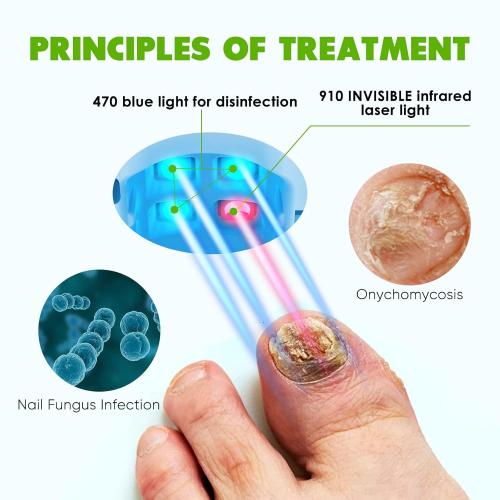 Nail Fungus Light for Toenails, FSA or HSA eligible Highly Effective Blue Light to Defeat Onychomycosis, Revolutionary Nail Fungus Solution Easy to Use at Home, Elderly