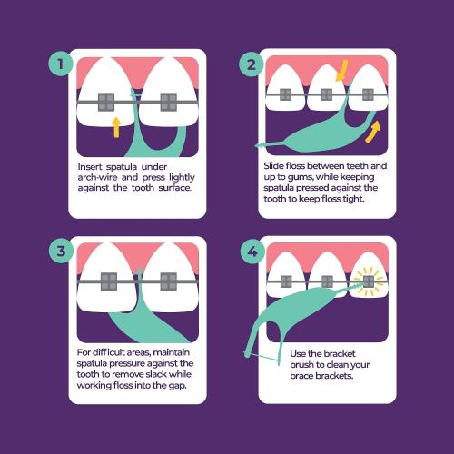 Platypus Orthodontic Flossers for Braces, 30 Count (Pack of 1), Ortho Picks for Adults & Kids, Fits Under Arch Wire, Non-Damaging, Encourage Flossing Habits