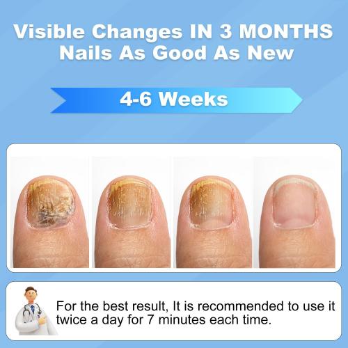 New Nail Fungus Device for Toenails & Fingernails, Home Use Toenail Fungus Treatment Device for Onychomycosis, Effective & Reliable (White) 2025