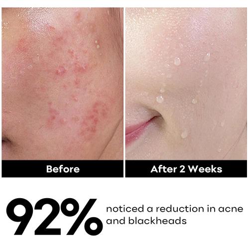 Pack of 2 Size 5.07 Salicylic Acid Face Cleanser, Daily Gentle Acne Cleansing Face Wash for Acne, Pore, Blackheads, Breakouts, Cleansing Gel for Oily & Sensitive Skin, 5.07 FL OZ