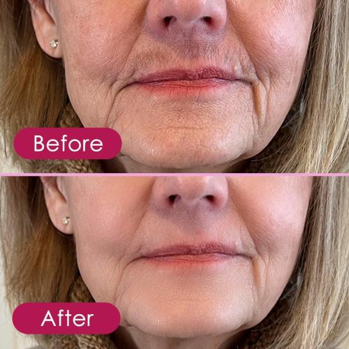 Pink and White Glabrouse Skin Epilator, Glabrous Skin Hair Remover for Face - Look Glamorous with Glabrousskin Hair Removal