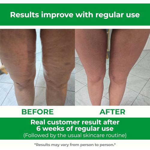TESMED Cellulite Manual Massager Roller for Thighs and Buttocks | Made in Italy and patented, with converging and diverging roller technology for targeted anti-cellulite massage.