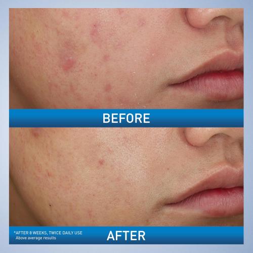 CeraVe Acne Foaming Cream Wash, Gentle Face and Body Cleanser with Benzoyl Peroxide 10%, Hyaluronic Acid, and Niacinamide, 10% Benzoyl Peroxide Treatment Clears Pimples and Blackheads 5 Oz