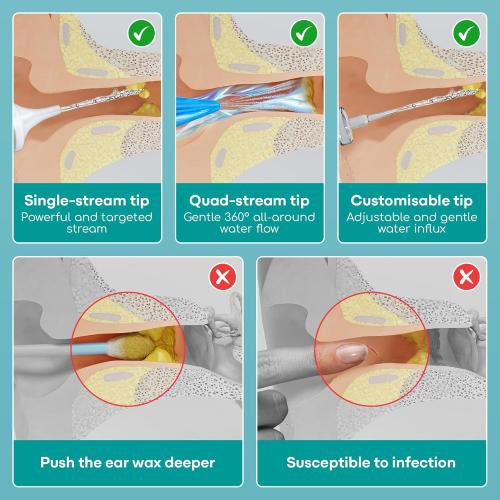 Medi Grade Ear Cleaning Kit Including Ear Cleaner Bottle, Basin with Quad-Stream tip - Earwax Removal Kit for Enhanced Hearing Clarity - Ear Wax Removal Tool for Ear Hygiene