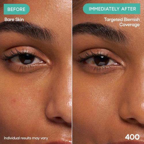 Almay Clear Complexion Concealer, 400, 0.3 fl oz | Full-coverage concealer treats acne and visibly evens skin tone over time. Instantly conceals breakouts. For acne-prone skin.