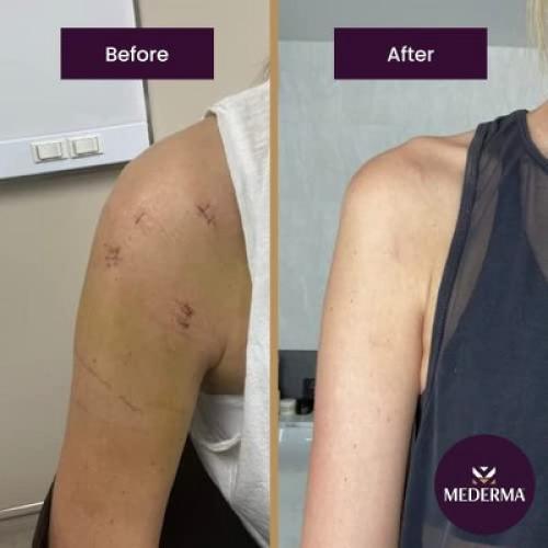 1.76oz Mederma Advanced Scar Gel 1.76 Oz