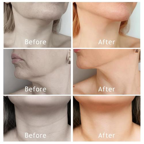 Neck Lift Strips, Invisible Neck Wrinkle Patches, High Elastic Neck Tapes for Double Chin Neck Jowls, Improve Neck Lines and Wrinkles, 20 pcs
